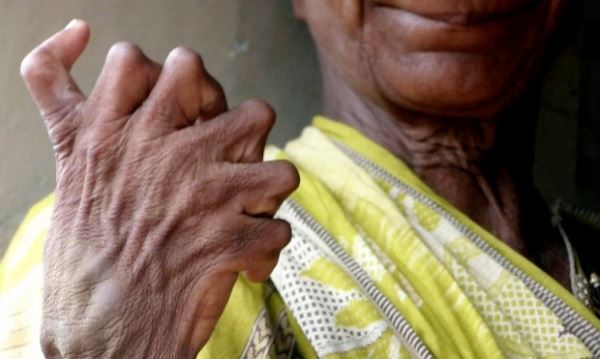 Жительница Индии имеет 19 пальцев на ногах и 12 на руках