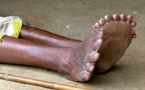 Жительница Индии имеет 19 пальцев на ногах и 12 на руках